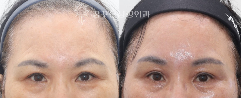 강남역 성형 전문의, 눈꺼풀 처짐 쌍꺼풀 수술로는 안된다고? 👀 해답은 내시경이마리프팅! 사진 12