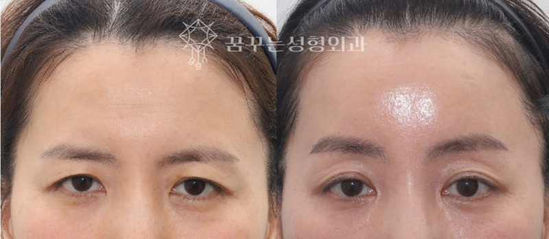 강남역 성형 전문의, 눈꺼풀 처짐 쌍꺼풀 수술로는 안된다고? 👀 해답은 내시경이마리프팅! 사진 11