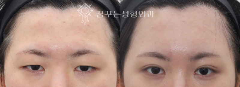 강남역 성형 전문의, 눈꺼풀 처짐 쌍꺼풀 수술로는 안된다고? 👀 해답은 내시경이마리프팅! 사진 9