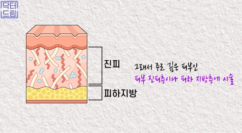 꺼진곳을 채우는, 보법이 다른 볼륨시술 원탑 쥬베룩 vs 쥬베룩볼륨 사진 5