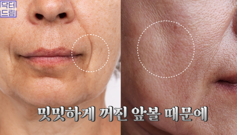 꺼진곳을 채우는, 보법이 다른 볼륨시술 원탑 쥬베룩 vs 쥬베룩볼륨 사진 6