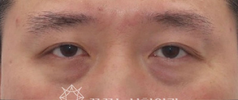 40대 눈밑지방재배치, 미루면 하안검 수술까지? 지금이 눈밑 안티에이징 골든타임입니다 | 강남역 꿈꾸는성형외과 사진 3