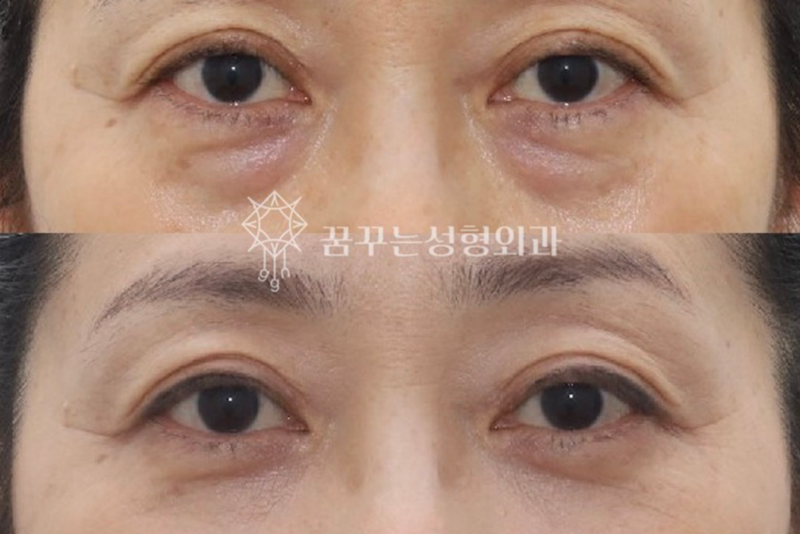 40대 눈밑지방재배치, 미루면 하안검 수술까지? 지금이 눈밑 안티에이징 골든타임입니다 | 강남역 꿈꾸는성형외과 사진 8