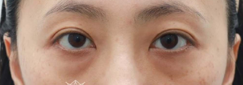 40대 눈밑지방재배치, 미루면 하안검 수술까지? 지금이 눈밑 안티에이징 골든타임입니다 | 강남역 꿈꾸는성형외과 사진 4