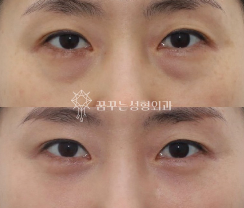 40대 눈밑지방재배치, 미루면 하안검 수술까지? 지금이 눈밑 안티에이징 골든타임입니다 | 강남역 꿈꾸는성형외과 사진 11