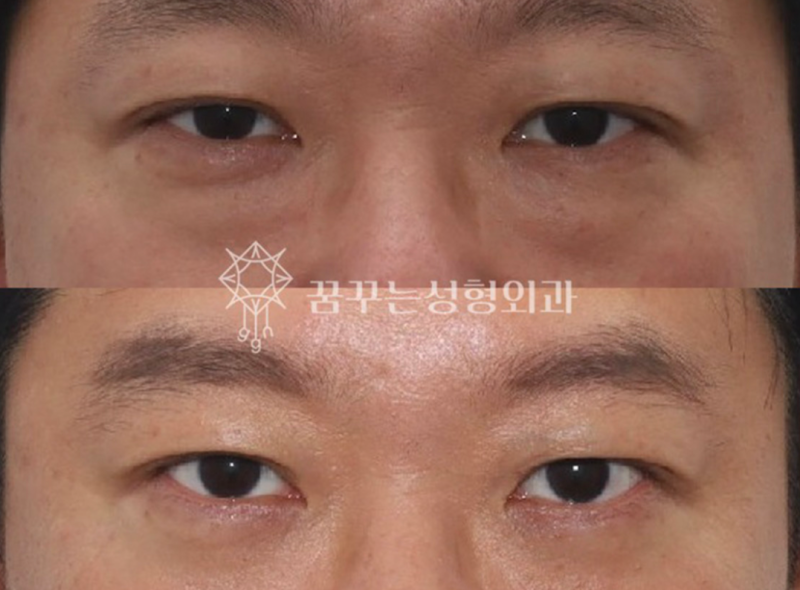 40대 눈밑지방재배치, 미루면 하안검 수술까지? 지금이 눈밑 안티에이징 골든타임입니다 | 강남역 꿈꾸는성형외과 사진 14