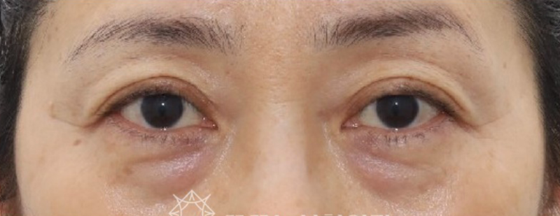 40대 눈밑지방재배치, 미루면 하안검 수술까지? 지금이 눈밑 안티에이징 골든타임입니다 | 강남역 꿈꾸는성형외과 사진 5