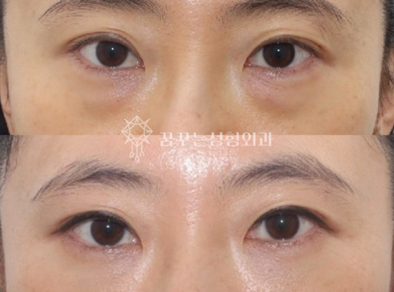 40대 눈밑지방재배치, 미루면 하안검 수술까지? 지금이 눈밑 안티에이징 골든타임입니다 | 강남역 꿈꾸는성형외과 사진 13