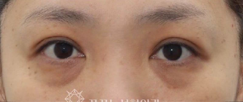 40대 눈밑지방재배치, 미루면 하안검 수술까지? 지금이 눈밑 안티에이징 골든타임입니다 | 강남역 꿈꾸는성형외과 사진 2