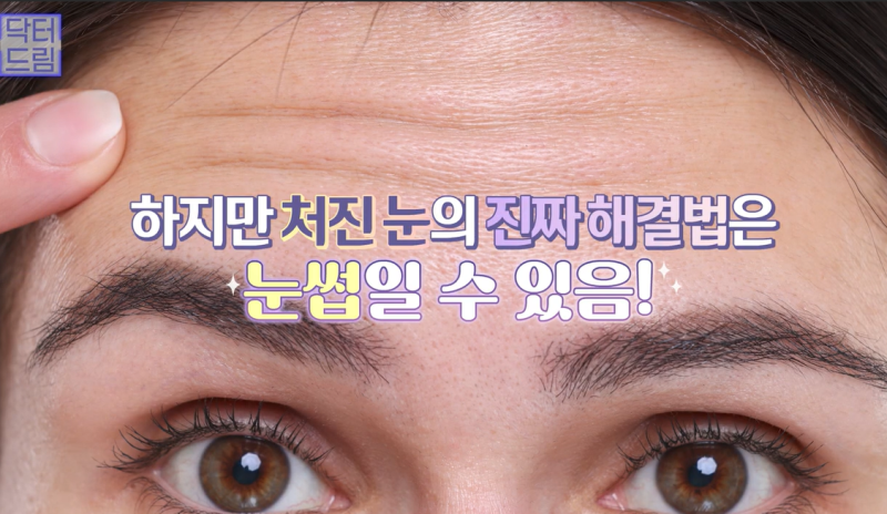 중년눈성형/눈처짐을 평정한 레전드 동안수술, 내시경이마거상 사진 4