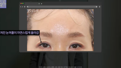 중년눈성형/눈처짐을 평정한 레전드 동안수술, 내시경이마거상
