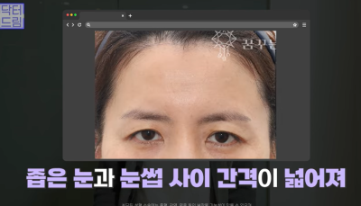 중년눈성형/눈처짐을 평정한 레전드 동안수술, 내시경이마거상 사진 13
