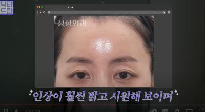 중년눈성형/눈처짐을 평정한 레전드 동안수술, 내시경이마거상 사진 14