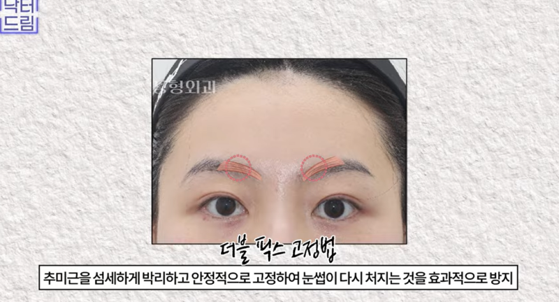 중년눈성형/눈처짐을 평정한 레전드 동안수술, 내시경이마거상 사진 19