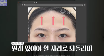중년눈성형/눈처짐을 평정한 레전드 동안수술, 내시경이마거상 사진 9