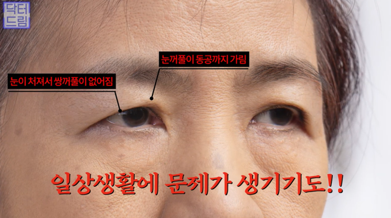 중년눈성형/눈처짐을 평정한 레전드 동안수술, 내시경이마거상 사진 3