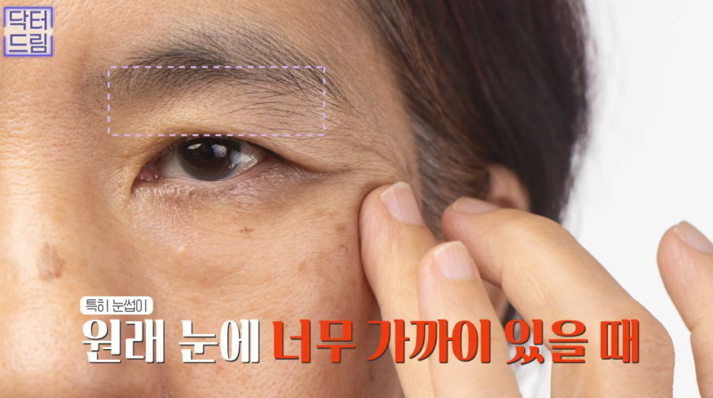 중년눈성형/눈처짐을 평정한 레전드 동안수술, 내시경이마거상 사진 5