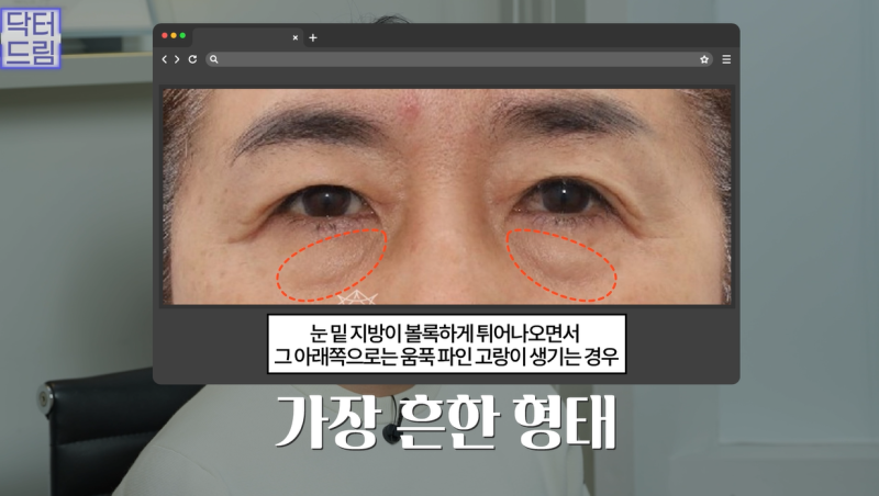 10살 늙어보이는 눈밑지방, 1시간만에 말끔히 해결됩니다 사진 8