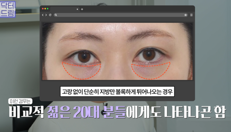 10살 늙어보이는 눈밑지방, 1시간만에 말끔히 해결됩니다 사진 9