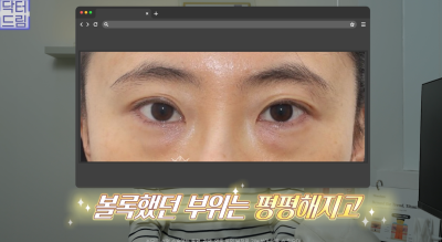 10살 늙어보이는 눈밑지방, 1시간만에 말끔히 해결됩니다 사진 20