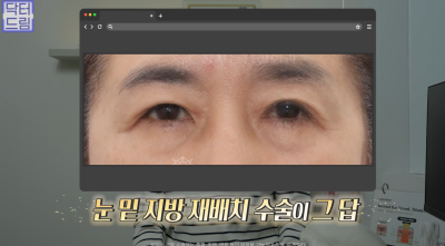 10살 늙어보이는 눈밑지방, 1시간만에 말끔히 해결됩니다 사진 14