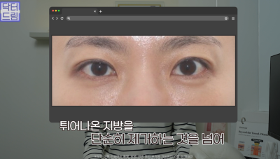 10살 늙어보이는 눈밑지방, 1시간만에 말끔히 해결됩니다 사진 17