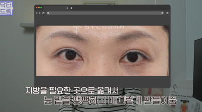 10살 늙어보이는 눈밑지방, 1시간만에 말끔히 해결됩니다 사진 19