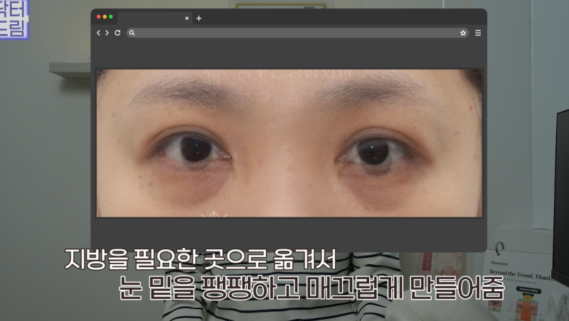 10살 늙어보이는 눈밑지방, 1시간만에 말끔히 해결됩니다 사진 10