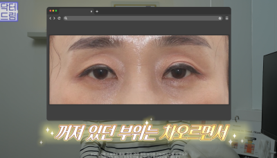 10살 늙어보이는 눈밑지방, 1시간만에 말끔히 해결됩니다 사진 23