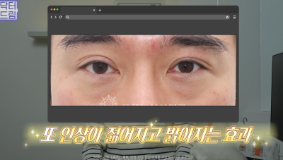 10살 늙어보이는 눈밑지방, 1시간만에 말끔히 해결됩니다 사진 24