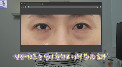10살 늙어보이는 눈밑지방, 1시간만에 말끔히 해결됩니다 사진 26