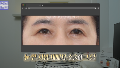 10살 늙어보이는 눈밑지방, 1시간만에 말끔히 해결됩니다 사진 15