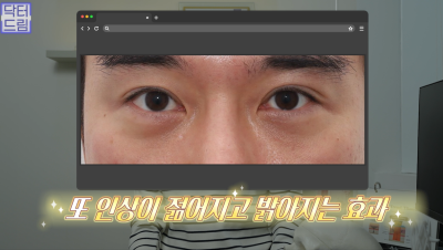 10살 늙어보이는 눈밑지방, 1시간만에 말끔히 해결됩니다 사진 25