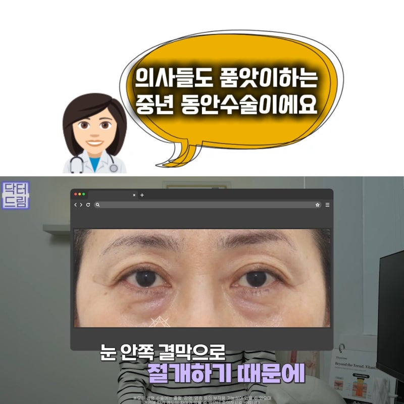 10살 늙어보이는 눈밑지방, 1시간만에 말끔히 해결됩니다
