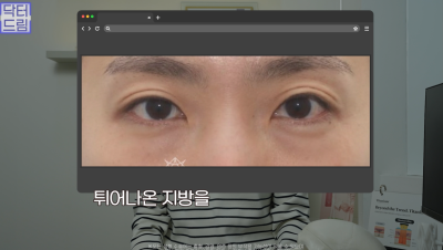 10살 늙어보이는 눈밑지방, 1시간만에 말끔히 해결됩니다 사진 16