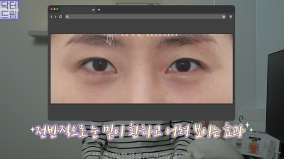 10살 늙어보이는 눈밑지방, 1시간만에 말끔히 해결됩니다 사진 27