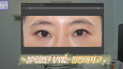 10살 늙어보이는 눈밑지방, 1시간만에 말끔히 해결됩니다 사진 21