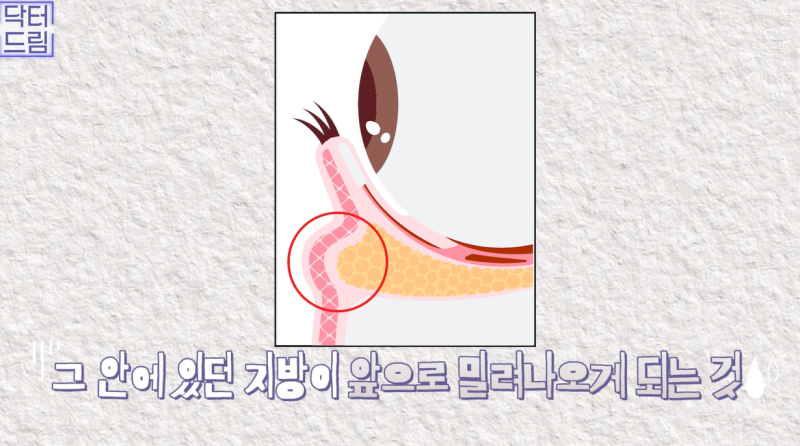 10살 늙어보이는 눈밑지방, 1시간만에 말끔히 해결됩니다 사진 6