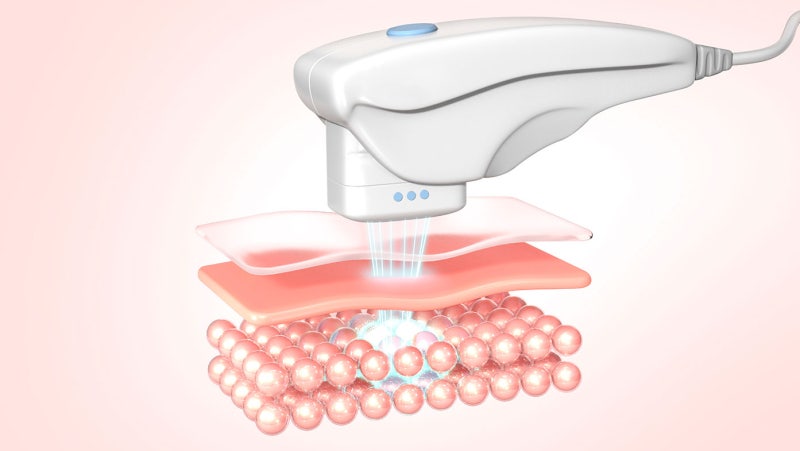 강남역 리프팅 피부시술 잘하는곳 텐써마·울쎄라·리쥬란 시너지로 피부 탄력 적금