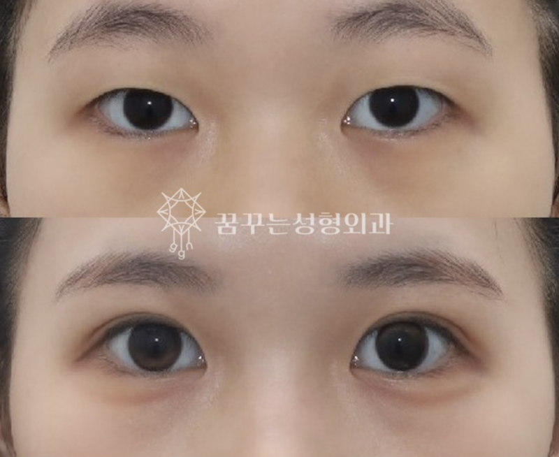 수능 끝! 강남역 자연유착 357펌라인으로 나에게 어울리는 쌍꺼풀 만들기, 대학생 새내기 첫 성형 사진 10