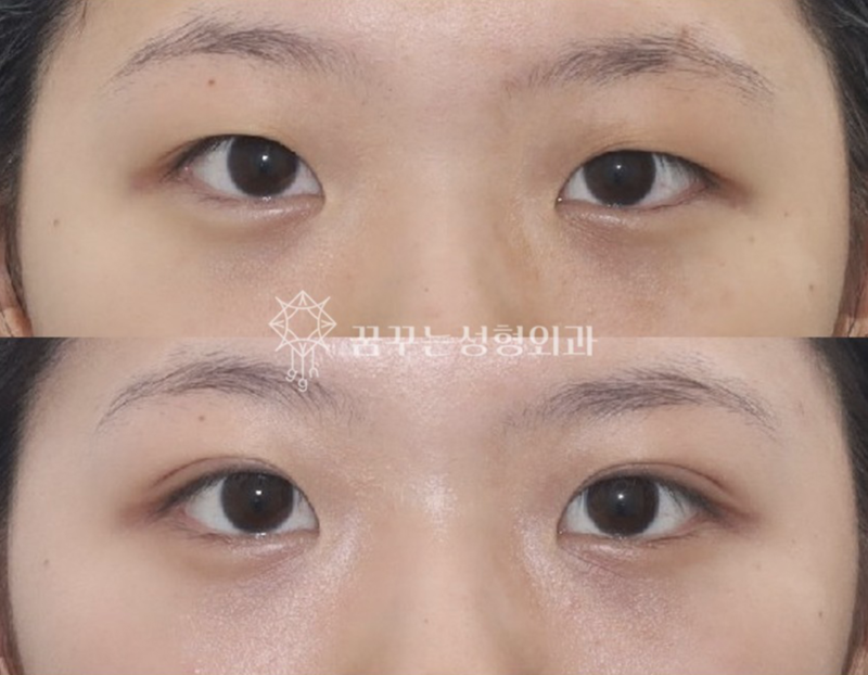 수능 끝! 강남역 자연유착 357펌라인으로 나에게 어울리는 쌍꺼풀 만들기, 대학생 새내기 첫 성형 사진 14
