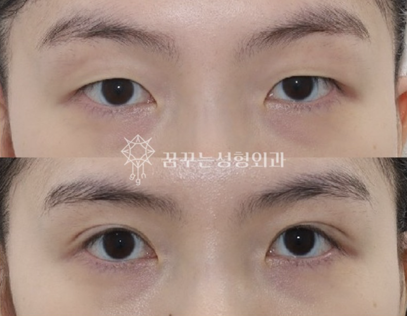 수능 끝! 강남역 자연유착 357펌라인으로 나에게 어울리는 쌍꺼풀 만들기, 대학생 새내기 첫 성형 사진 9