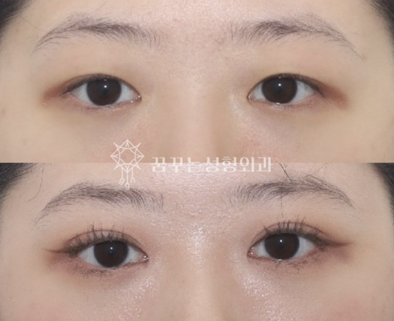 수능 끝! 강남역 자연유착 357펌라인으로 나에게 어울리는 쌍꺼풀 만들기, 대학생 새내기 첫 성형 사진 15