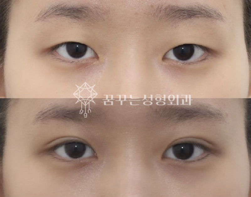 수능 끝! 강남역 자연유착 357펌라인으로 나에게 어울리는 쌍꺼풀 만들기, 대학생 새내기 첫 성형 사진 12
