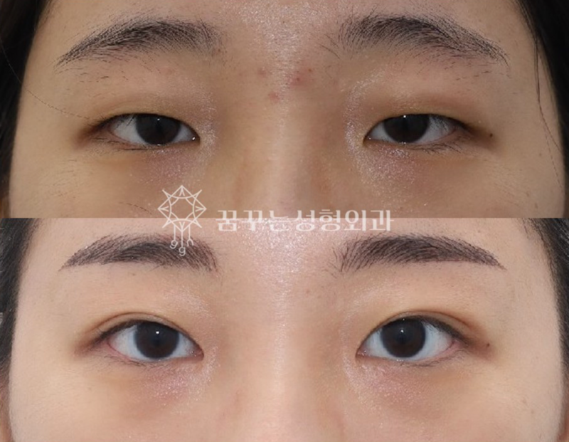 수능 끝! 강남역 자연유착 357펌라인으로 나에게 어울리는 쌍꺼풀 만들기, 대학생 새내기 첫 성형 사진 16