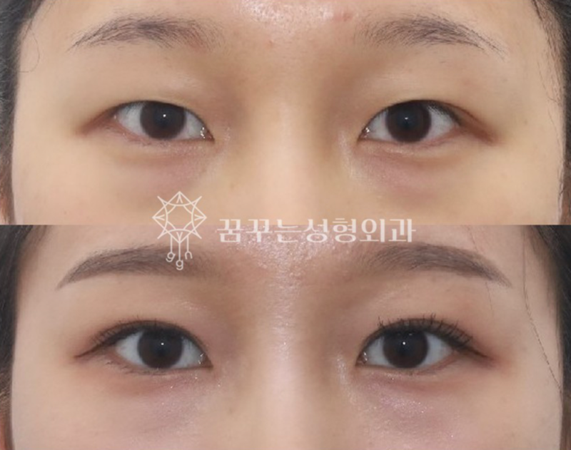 수능 끝! 강남역 자연유착 357펌라인으로 나에게 어울리는 쌍꺼풀 만들기, 대학생 새내기 첫 성형 사진 11