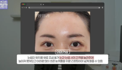 윗집 아줌마 쌍꺼풀 망했다며? 중년쌍꺼풀은 따로 있는데 아가씨들 하는걸 했대.. 사진 16