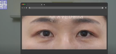 윗집 아줌마 쌍꺼풀 망했다며? 중년쌍꺼풀은 따로 있는데 아가씨들 하는걸 했대.. 사진 11
