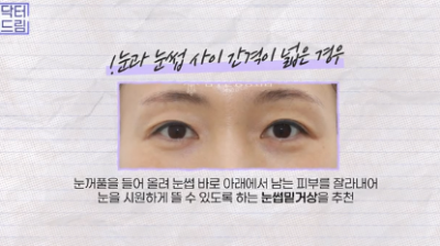 윗집 아줌마 쌍꺼풀 망했다며? 중년쌍꺼풀은 따로 있는데 아가씨들 하는걸 했대.. 사진 7