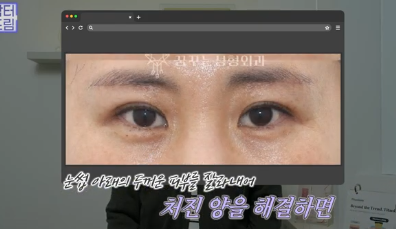 윗집 아줌마 쌍꺼풀 망했다며? 중년쌍꺼풀은 따로 있는데 아가씨들 하는걸 했대.. 사진 9